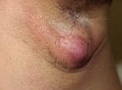 Ce este Hidradenitis supurative