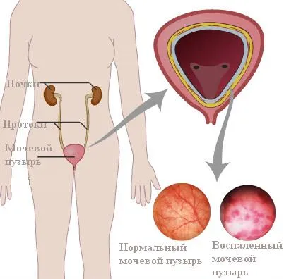 Ципрофлоксацин цистит предимства и недостатъци