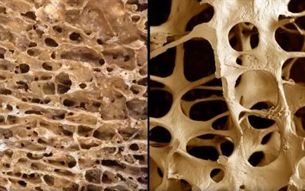 Denzitometriát osteoporosis diagnosztikája