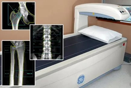 Denzitometriát osteoporosis diagnosztikája