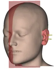 Ekzoprotezirovanie fata - protetica faciale, protetică ureche Pinna,