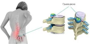 Extrudarea discului intervertebral, aspectul procesului de extrudare