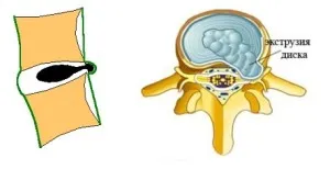 Extrudarea discului intervertebral, aspectul procesului de extrudare