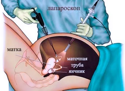 Еко след лапароскопия за това какво е необходимо и как процедурата