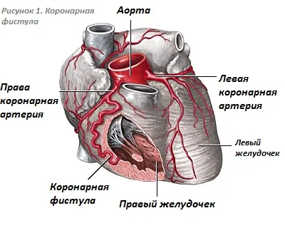 fistula arterelor coronare - coronariene arteriovenoase fistule (fistulă arterio) și coronariană