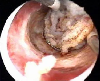 Endometrium hiperplázia - tünetek és kezelés