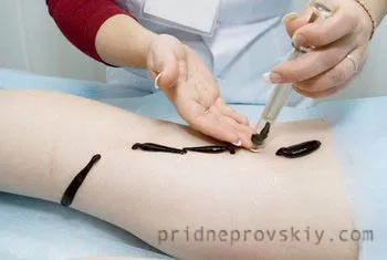 Hirudotherapy pióca terápia - igénybe Prydniprovsk, Fehéroroszország