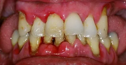 Purulentă parodontita - Enciclopedia stomatologie
