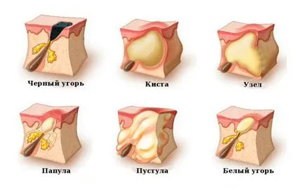 Hormonális oka az akne és a fő kezelési módszerek