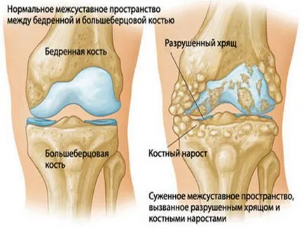 Osteoartrita a genunchiului - cauze, simptome si modul de a trata