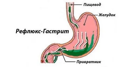 Как и къде го боли прегледа на стомаха гастрит на ефективни лекарства е за облекчаване на болката