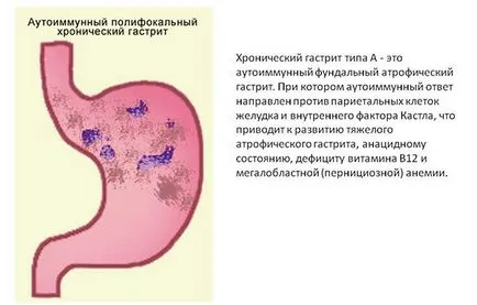 Как и къде го боли прегледа на стомаха гастрит на ефективни лекарства е за облекчаване на болката