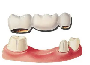 Fogászat „denttoriya” - hidak