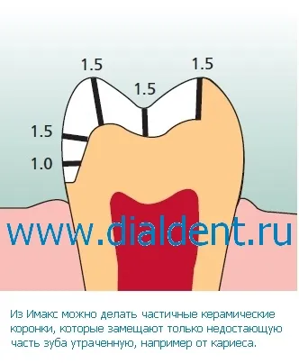 ceramica dentara (IMAX) - un material modern, utilizat în dial-Dent