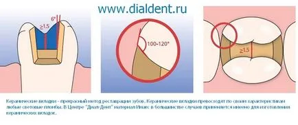 ceramica dentara (IMAX) - un material modern, utilizat în dial-Dent