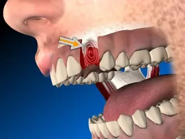 Cum de a opri sângerarea după extracția dentară, în cazul în care sângerarea nu se oprește pentru o lungă perioadă de timp