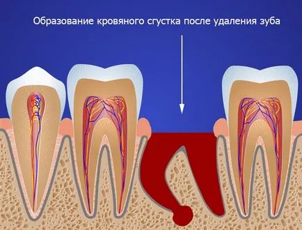 Cum de a opri sângerarea după extracția dentară, în cazul în care sângerarea nu se oprește pentru o lungă perioadă de timp