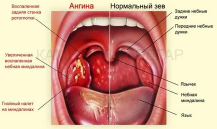 Cum de a proteja copilul de angină pectorală