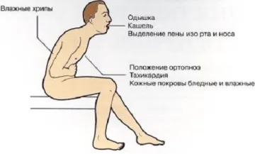 edem pulmonar cardiogen și periculos decât să-l elimine ca