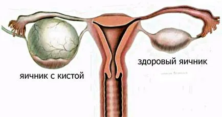 Киста на яйчниците и неговите симптоми при жените как да се разпознават и лекуват