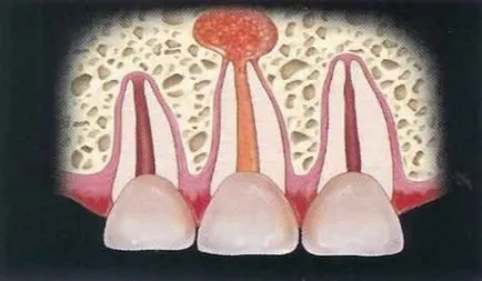 Киста на зъб корен - симптоми и лечение