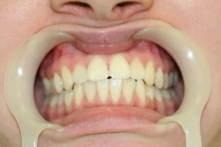 Киста на зъб корен - симптоми и лечение