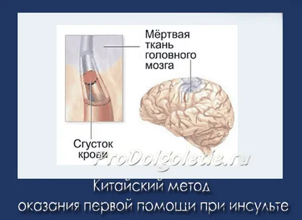 Chineză metoda de prim-ajutor de accident vascular cerebral, medicina orientală, întinerire și longevitate