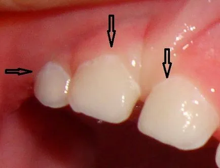 Cariile care este, de ceea ce apare bacterii patogene