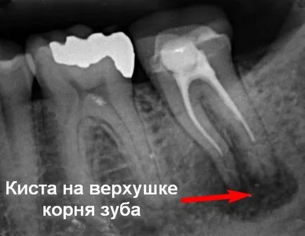 Chist pe radacina dintelui - simptome și tratament