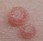 Tratamentul Molluscum contagiosum, simptome, metode de infecție