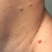 Molluscum contagiosum kezelés, a tünetek a fertőzés módja