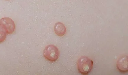 Molluscum contagiosum gyermekek tünetei és kezelése