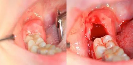 Кървене след отстраняване на мъдреци - как да се спре кръвта от раната