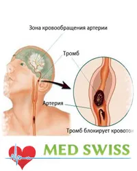 A kezelés a stroke Kínában, a hasznosítás után a stroke Kínában