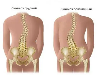 Se tratează scolioză și cifoză imediat