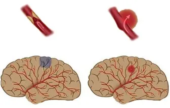 accident vascular cerebral de tratament în medicina chineză