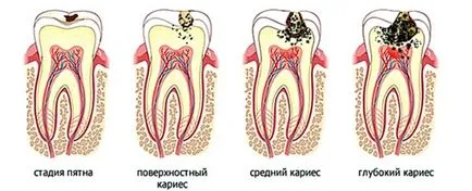 Стоматологично лечение евтин, високо качество, цена на стоматологично лечение в клиниката 