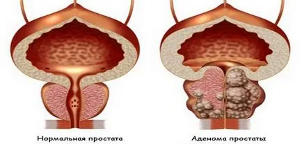 ВРН Лечение сода по метода Neumyvakina