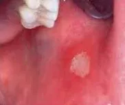 Leukoplakia - Лечение и Симптоми