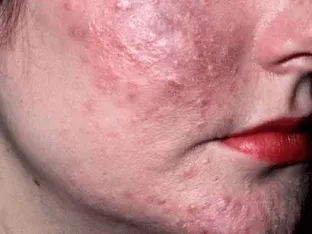 Face atka Demodex, hogyan kell kezelni, az első 03 Diseases könyvtár az emberi betegségek