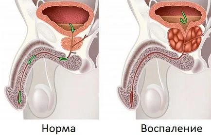 Terapia magnetica pentru eficienta de prostata si normele de aplicare