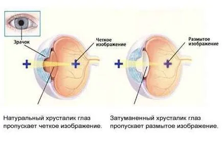 Metodele tradiționale de tratament al cataractei