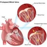 Nerespectarea de valva mitrala (regurgitare mitrala) Clinica, diagnosticare - medicale