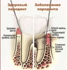 Неприятна миризма от гърлото, което причинява и как да се отървете от