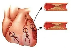 Non-invazív, Q-negatív miokardiális infarktus vagy a myocardialis infarktus nélkül magassági st