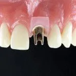Áttekintés a fogászati ​​implantátumok IMPRO, azok előnyeit és az ár