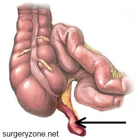 Akut appendicitis gyermekeknél - gyermeksebészet