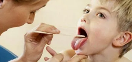 Szövődmények mandulagyulladás felnőttek és gyermekek