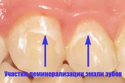 Избелване на зъби народни средства у дома Преглед