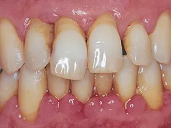 A periodontitis - okai, tünetei, diagnózisa és kezelése